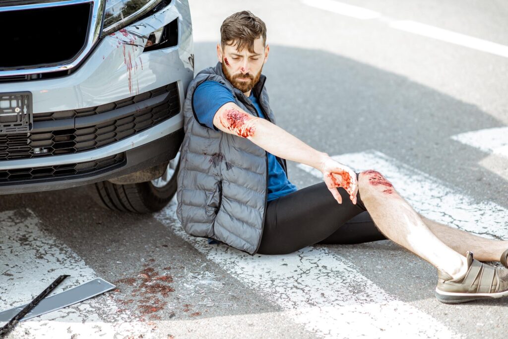 Injured man with bloody wounds sits on a crosswalk beside a car after a hit & run accident, with visible blood on his arm, hand, and leg. - Ghassemi Law Group Injured man with bloody wounds sits on a crosswalk beside a car after a hit & run accident, with visible blood on his arm, hand, and leg.