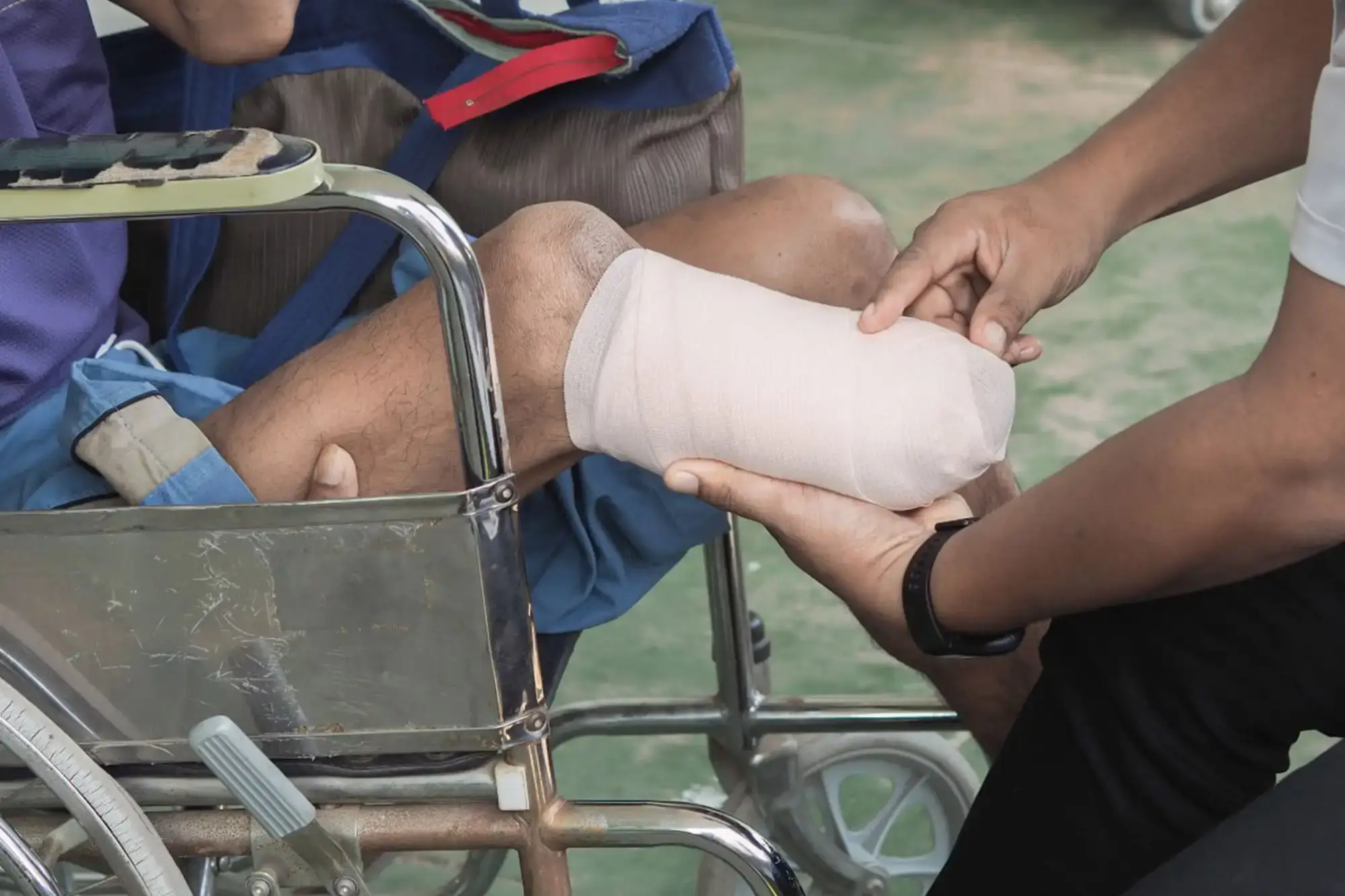 A person in a wheelchair has a bandaged amputation on their leg. Another person is gently supporting the bandaged limb with both hands. - Ghassemi Law Group - Ghassemi Law Group A person in a wheelchair has a bandaged amputation on their leg Another person is gently supporting the bandaged limb with both hands